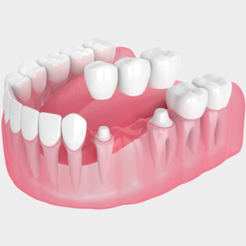 Brampton dental office dental bridge model