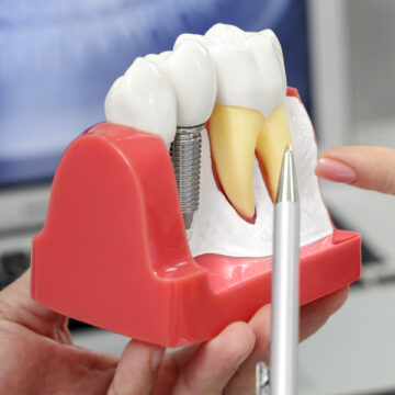 Brampton dental clinic dental implants model