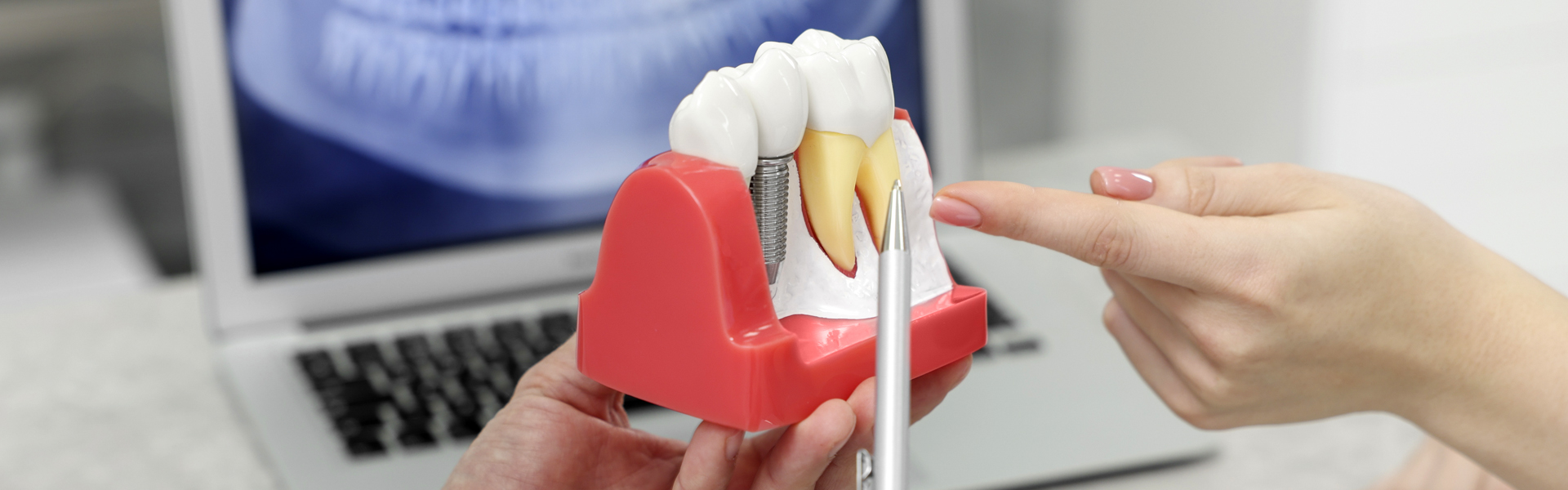 Brampton dental clinic dental implants model