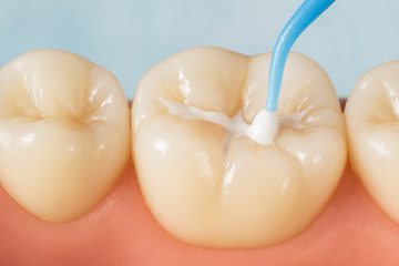 How Long Do Dental Sealants Really Last? What You Need to Know